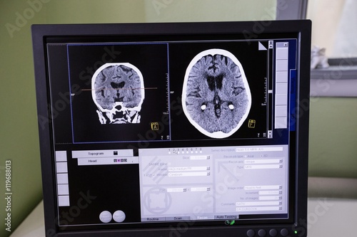 Close-up of digital brain scan on computer monitor