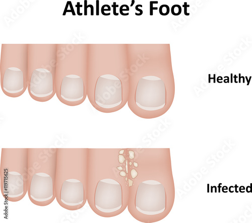 Athlete's Foot Diagram