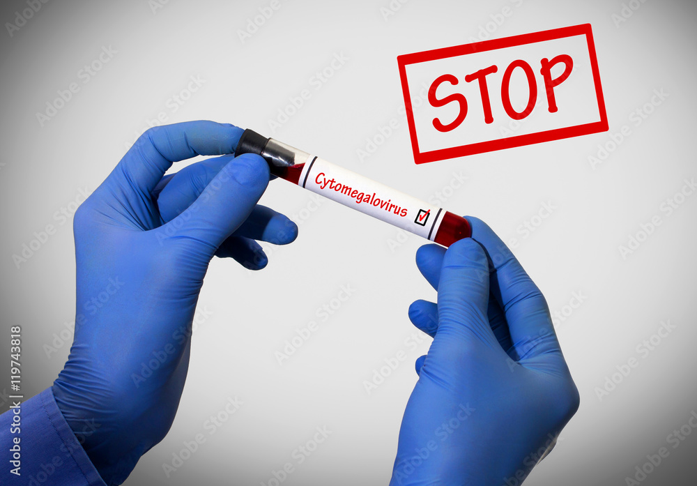 Stop cytomegalovirus Stop cytomegalovirus