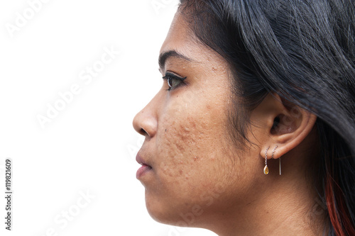 acne on skin face women