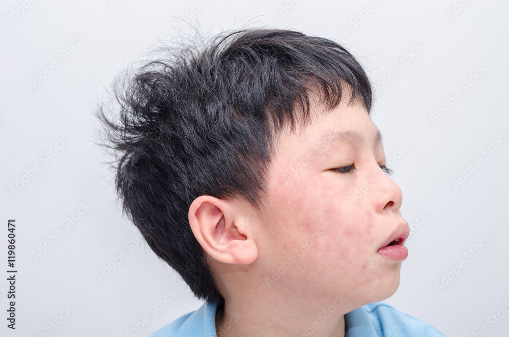 Closeup face of young asian boy with rash from allergy Closeup face of young asian boy with rash from allergy