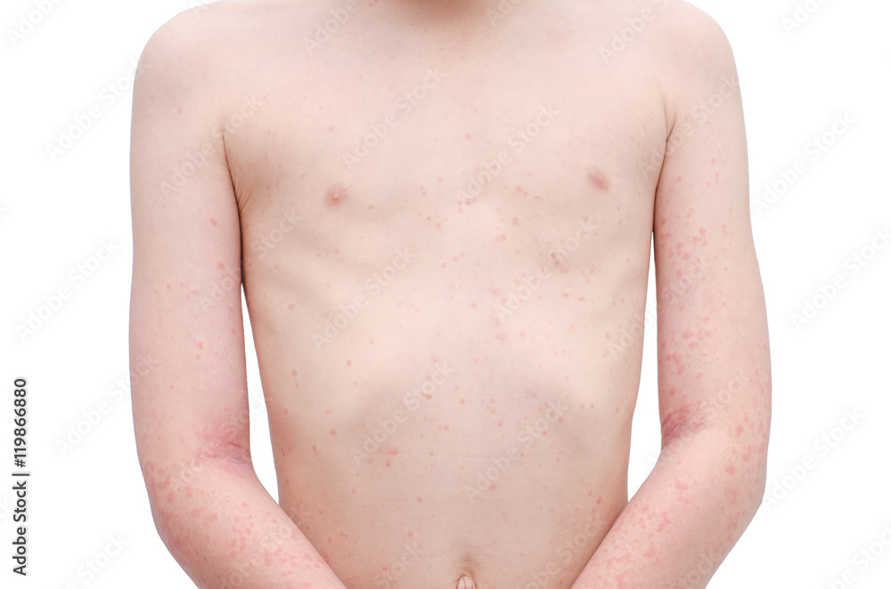 Young asian child skin with rash over white background Young asian child skin with rash over white background
