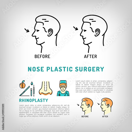 Rhinoplasty Nose Plastic Surgery logos. Face Plastic surgery concept thin line icons. Medical symbols before and after Vector illustration