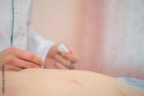 Photo of acupuncture treatments  placement of medical needles on the patient  close-ups