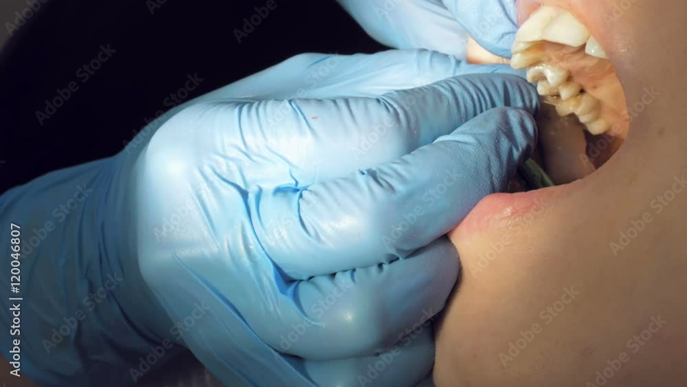 Woman at the dentist clinic office gets dental medical examination and treatment. Close up shot. Odontic and mouth health is important part of modern human life that dentistry help with. Woman at the dentist clinic office gets dental medical examination and treatment. Close up shot. Odontic and mouth health is important part of modern human life that dentistry help with.