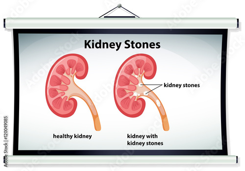 Diagram showing kidney stones