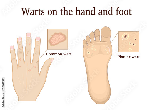 Warts on the hand and foot depicted in general and close-up