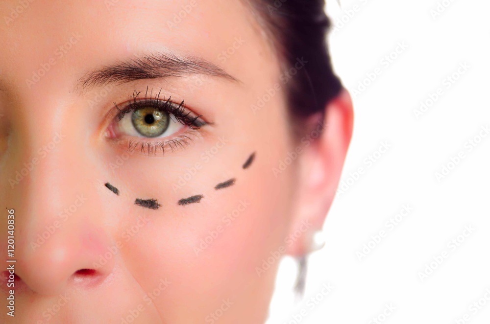Closeup half of face caucasian woman with dotted lines drawn around left eye, preparing cosmetic surgery Closeup half of face caucasian woman with dotted lines drawn around left eye, preparing cosmetic surgery