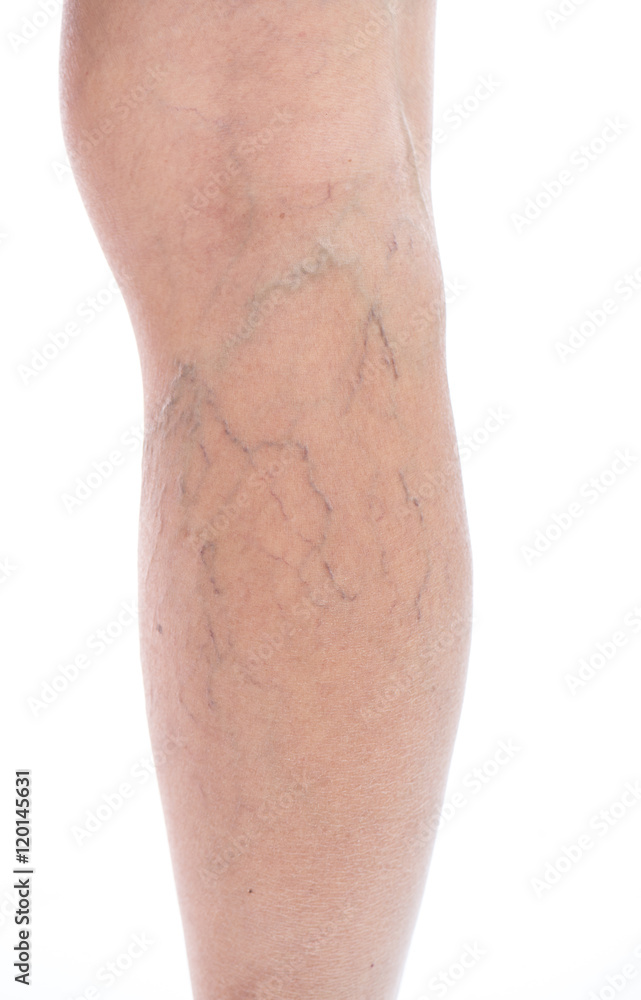 Varicose vein Isolated on white Varicose vein Isolated on white