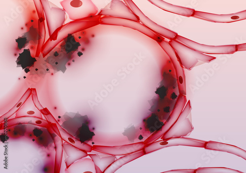 Inflamed Alveoli in Lungs Tissue Slice, Cross section, Smoke Tar - Vector Illustration