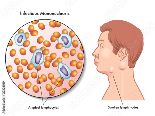 mononucleosis photo