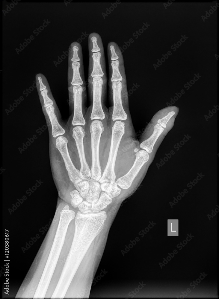Hand x-ray of healthy subject (Human bone) Hand x-ray of healthy subject (Human bone)