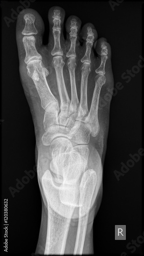 Radiograph of Human foot