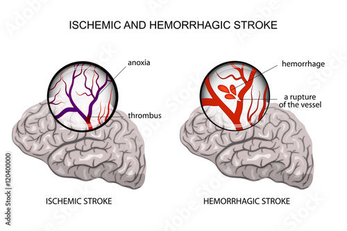hemorrhagic and ischemic stroke photo
