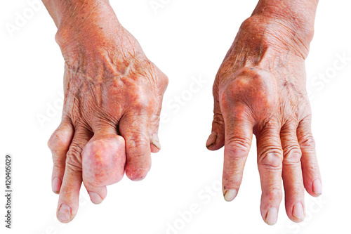 hands of gout patient photo