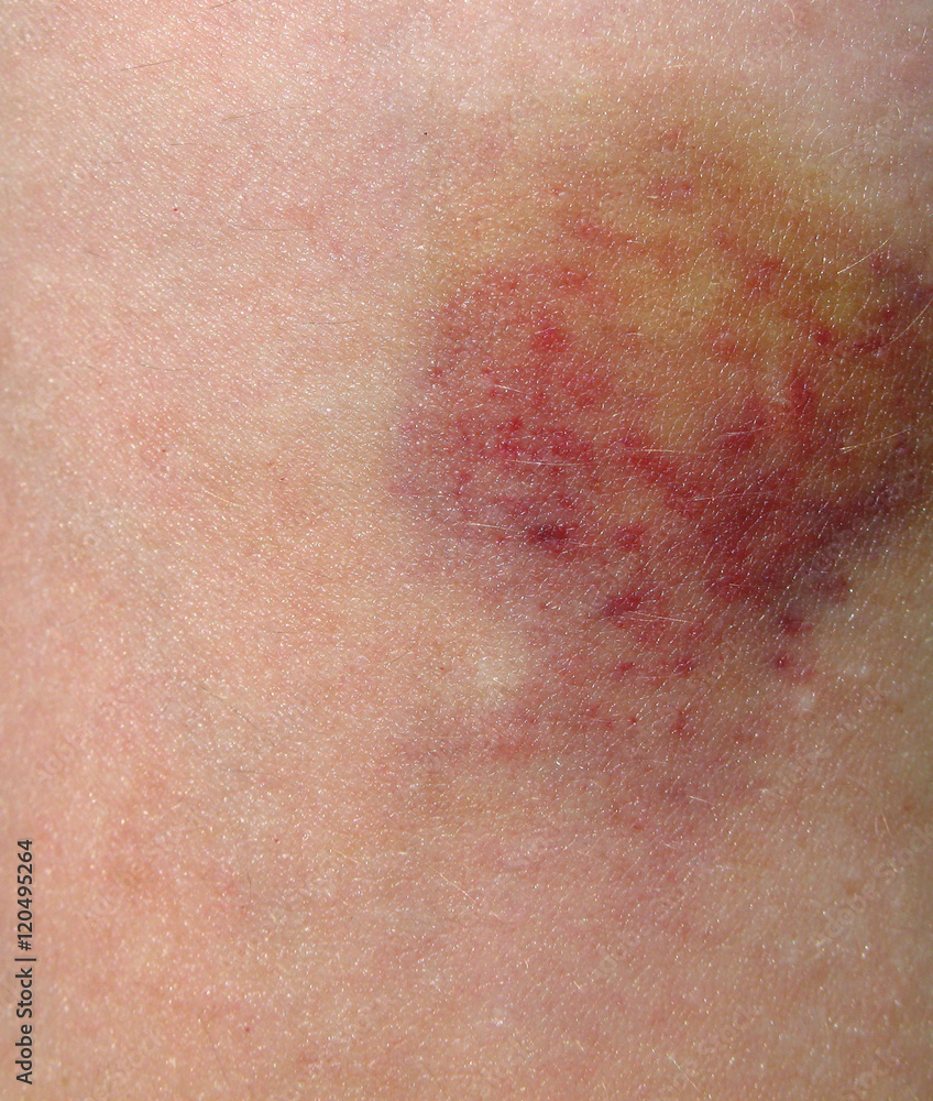 Bruised Skin Bruised Skin