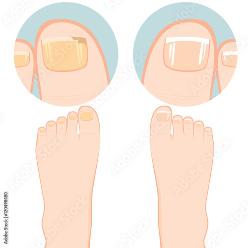 Close up of two feet one with nail fungal infection and other healthy