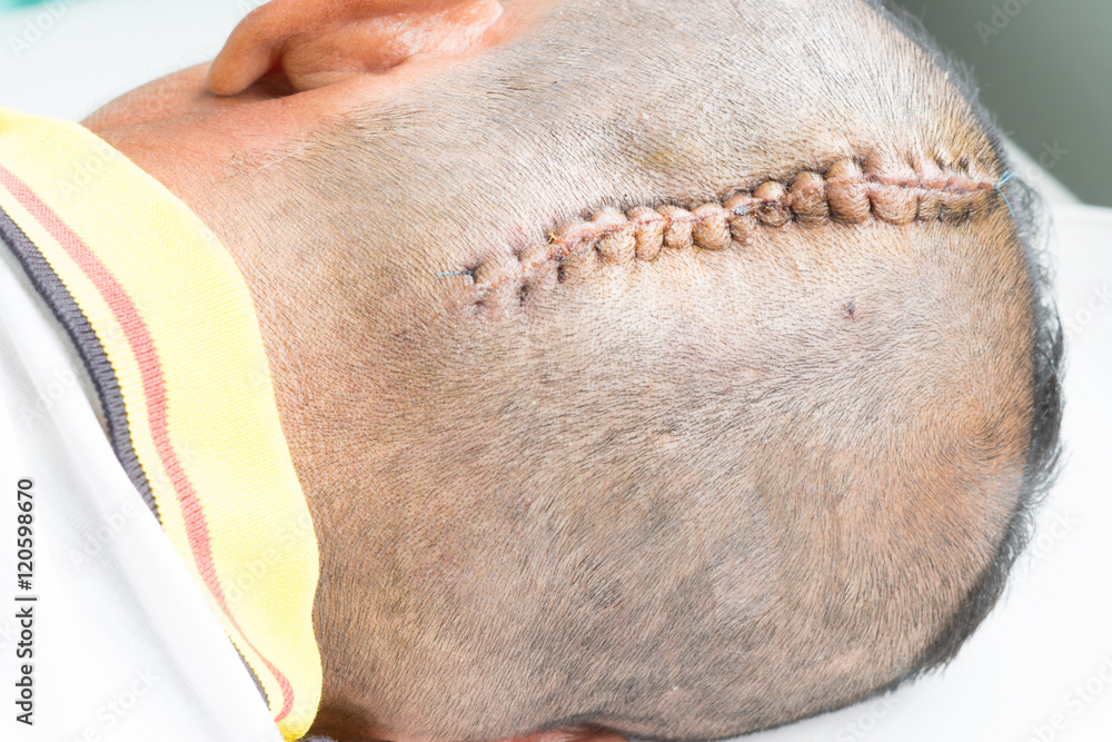 Naklejka premium head injury,suture.