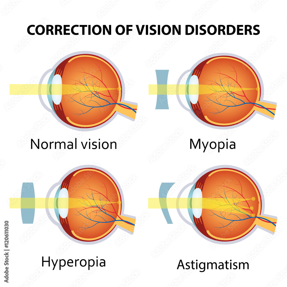 Correction of various eye vision disorder.