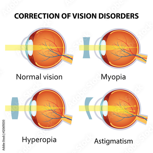 Correction of various eye vision disorder.