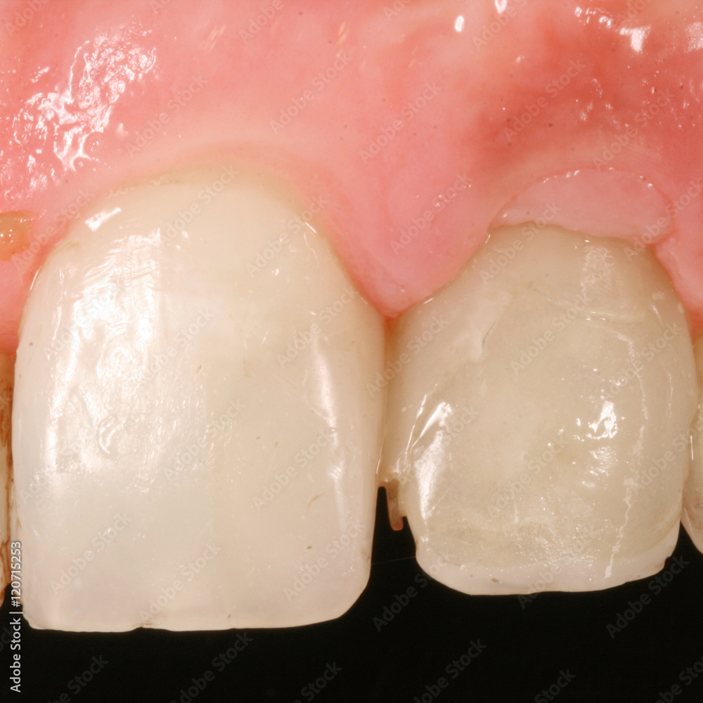 Fototapeta premium dental surjery implant view