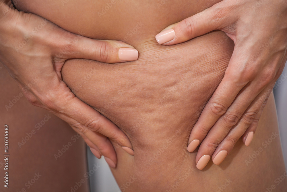 Girl shows holding and pushing the skin of the legs cellulite, orange peel. Treatment and disposal of excess weight, the deposition of subcutaneous fat tissue