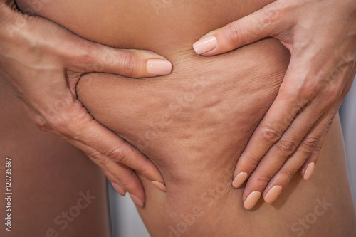 Girl shows holding and pushing the skin of the legs cellulite, orange peel. Treatment and disposal of excess weight, the deposition of subcutaneous fat tissue photo