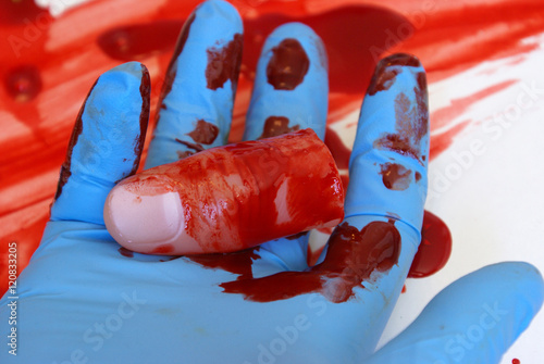 Operation Severed Thumb photo