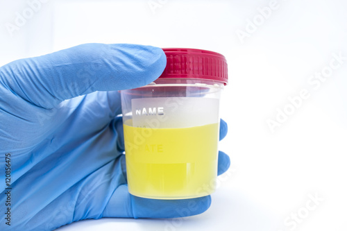 Doctor in laboratory holding a container of urine in hand, dressed in a blue latex glove before taking biological material to be loaded into the analyzer and conduct of urinalysis close up front view photo