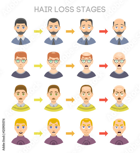 Baldness stages vector set.