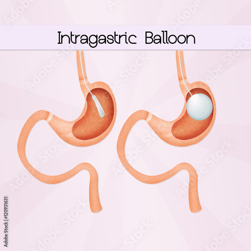 intragastric balloon photo