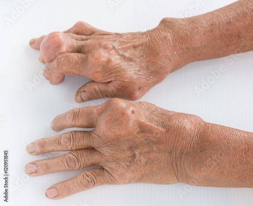 Fingers of patient with gout. photo
