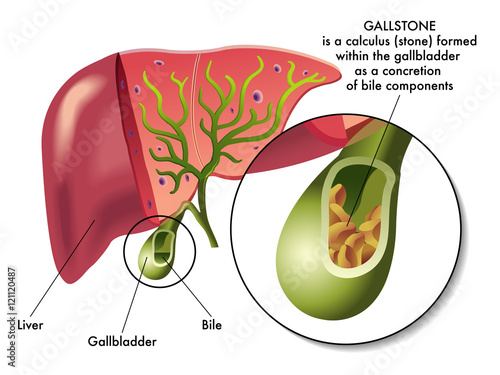 gallstones photo