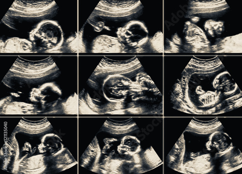 Schilderij op canvas Ultrasound scans collage during pregnancy at the end of third mo