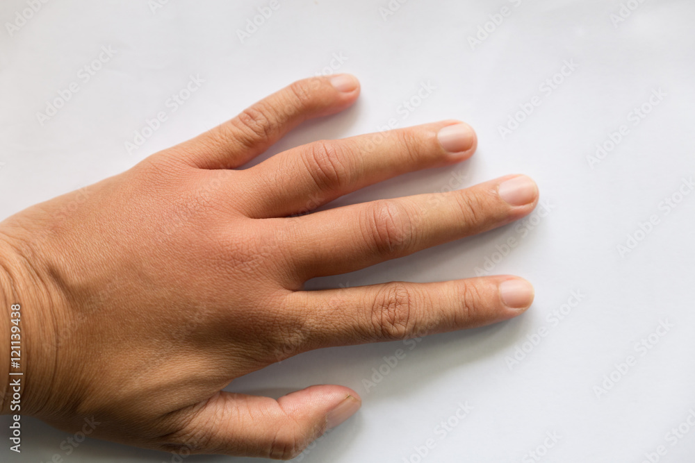 swollen hand from wasp sting swollen hand from wasp sting