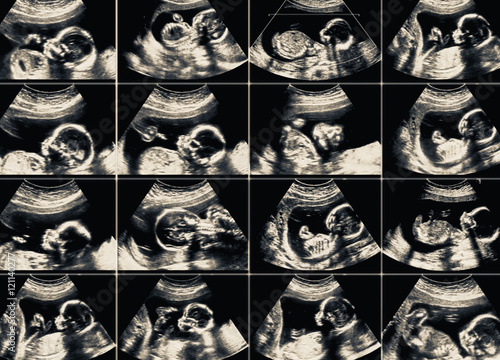 Fotografie Collage of 16 ultrasonography fetus pictures