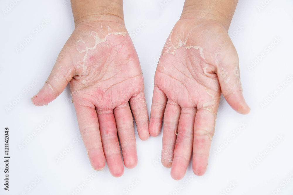 Dry hands, peel, Contact dermatitis, fungal infections, Skin inf Stock
