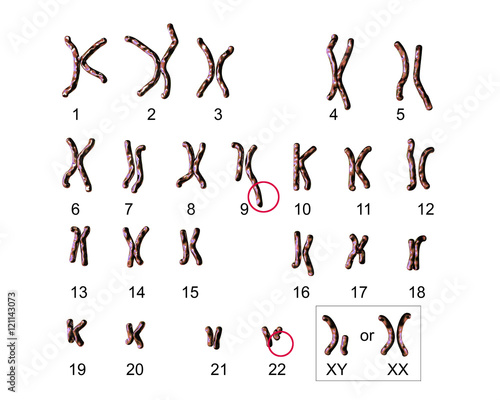 Philadelphia chromosome karyotype male or female. 3D illustration showing defective 9 and 22 chromosomes with translocational defect which causes cause chronic myelogenous leukaemia photo