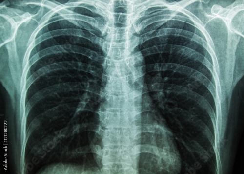 X-Ray Image Of Human Chest for a medical diagnosis