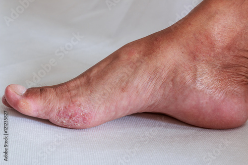 Foot is a fungal infection