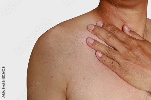 Man with dermatitis problem of rash ,Allergy rash shoulder area