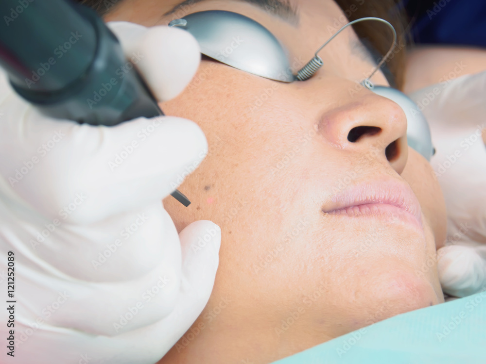 Asian woman patient on laser procedure skin resurfacing in aesthetic medicine. Asian woman patient on laser procedure skin resurfacing in aesthetic medicine.