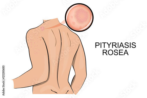 the skin affected by ringworm pink. pityriasis rosea. photo