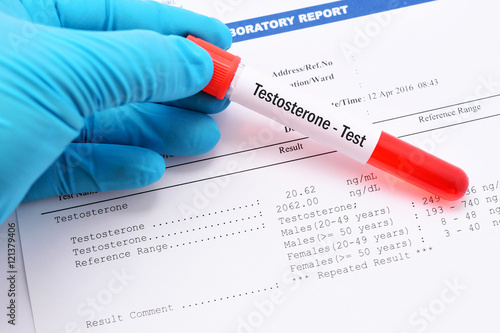 Blood sample for testosterone hormone test with result photo