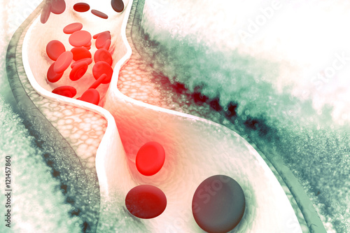 Cholesterol plaque in artery