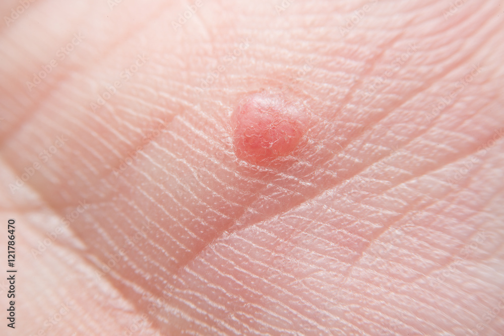 Red mole on hand Red mole on hand