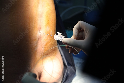 epidural anesthesia