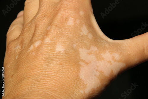 Weißfleckenkrankheit an der Hand
