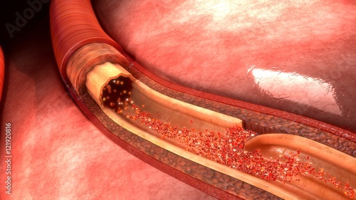 Obraz na płótnie Artery Dissection