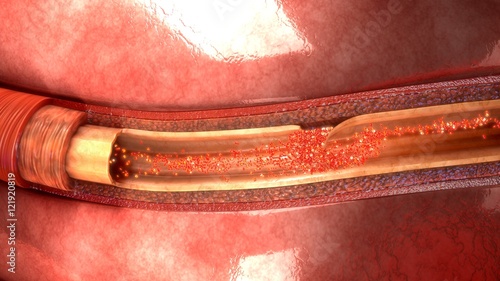 Foto Artery Dissection